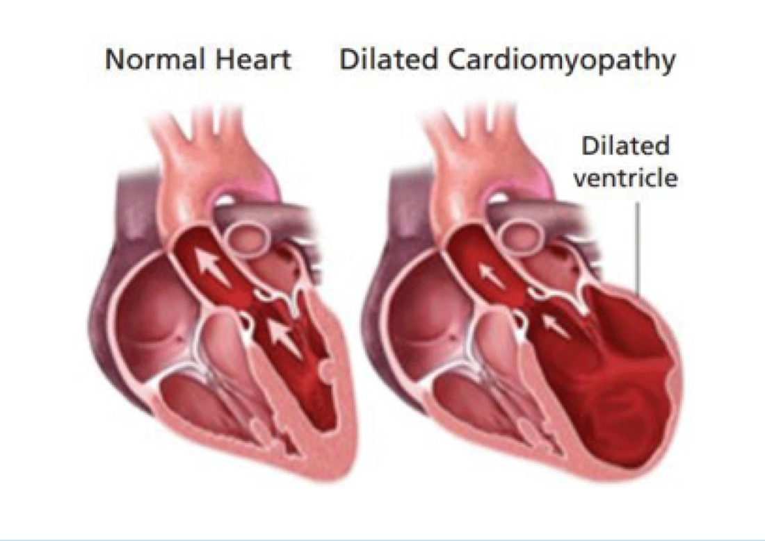 Taurine deficient outlet dilated cardiomyopathy